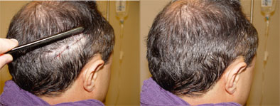 Image directly after FUT hair transplantation. The wound and harvesting is hidden by the longer hairs in the donor area 
