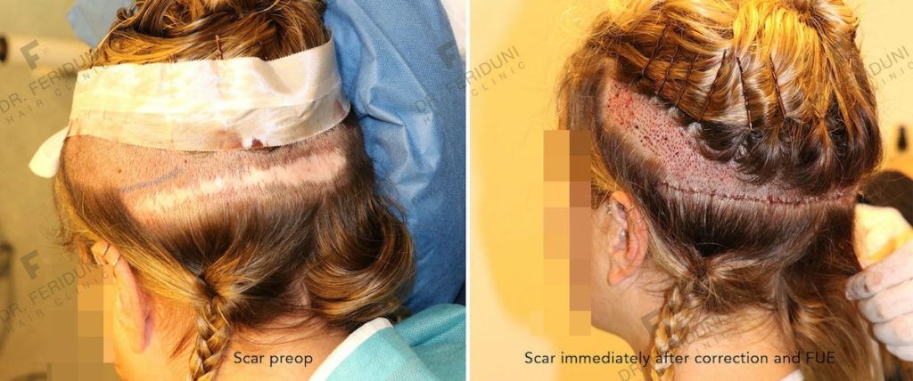 The FUT scar on the left before and on the right directly after the scar repair. Also on the right the receiving area of the further FUE hair transplant with a strip shave