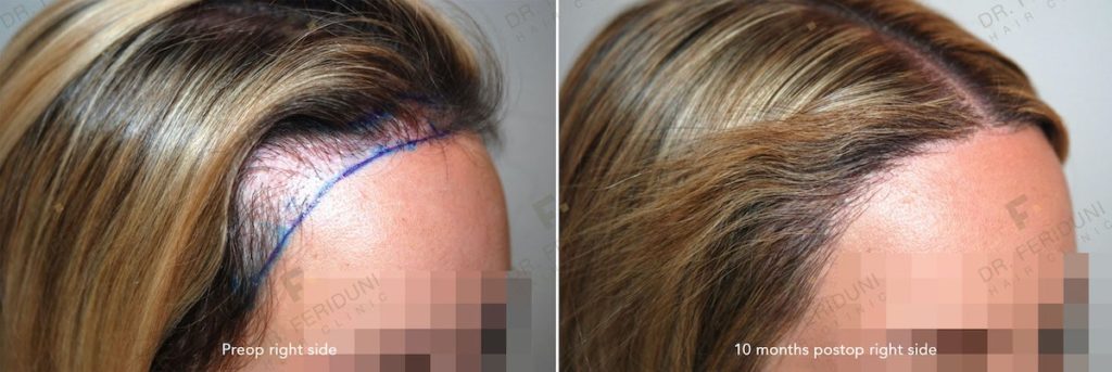 The result of the female FUE repair correction from close up