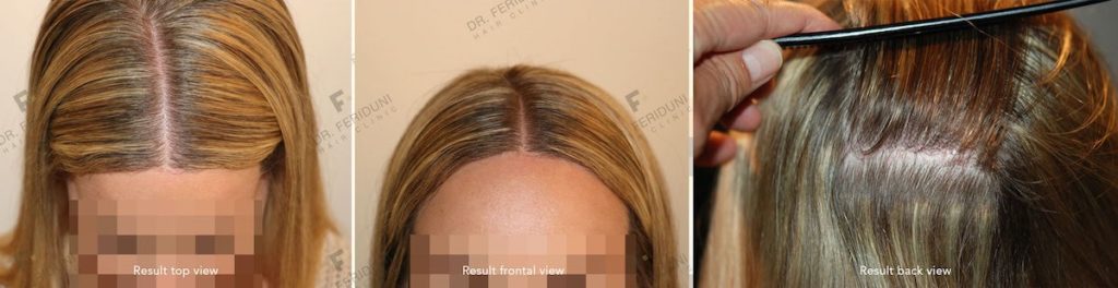 The result of the female patient with the FUE procedure and the picture on the far right the result of the scar correction with Trichophytic-Closure closure technique