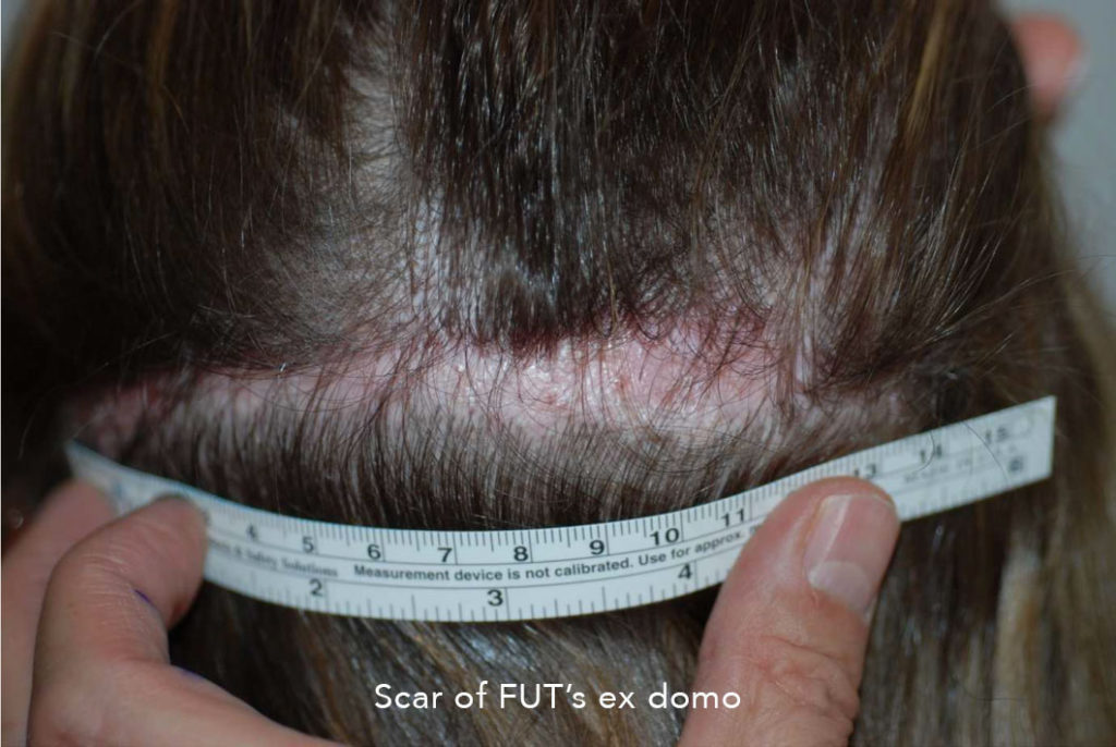 The scar of the previous FUT strip hair transplant with poor experience - Before scar correction