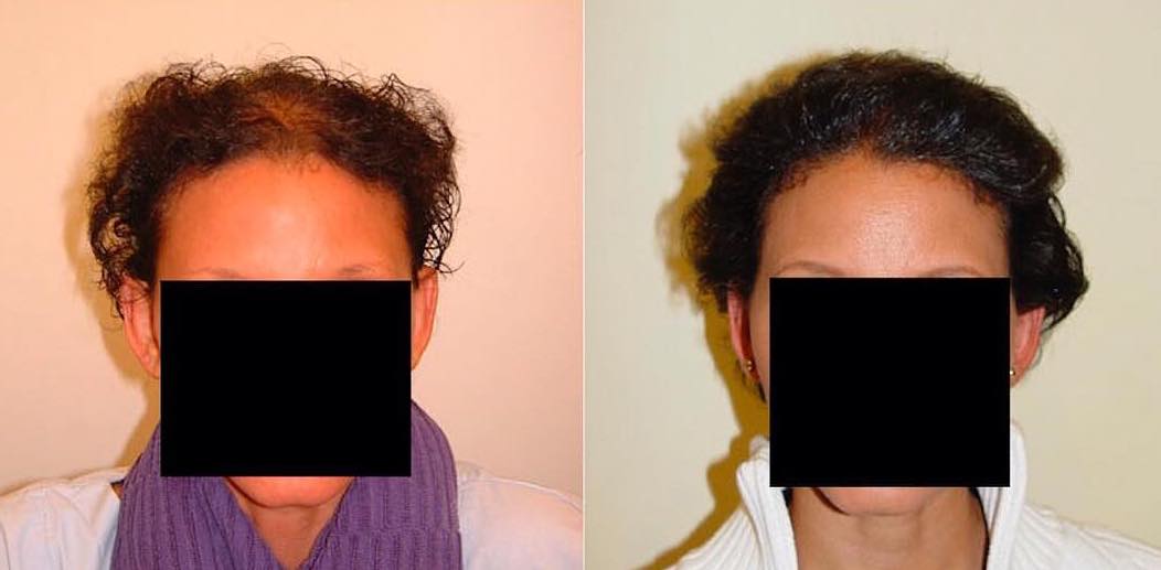 Female Hair loss and thinning hair in the middle parting before and after a density increase through a hair transplant