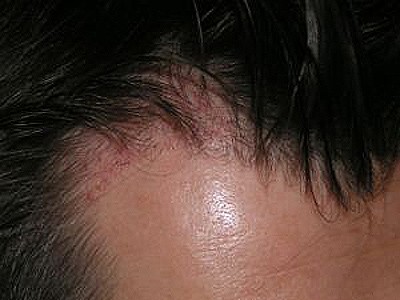 Meine Erfahrungen 1 Monat nach der Haarverpflanzung mit negativer Tendenz: Immer noch eine starke Rötung mit tiefen Furchen
