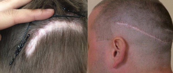 Hair transplantation risks in the donor area with FUT - examples:  Strip extraction and the risk of wider linear scars