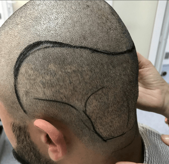 Example of donor restocking from the Hairlineclinic in FUE scars or a decimated FUE donor - drawing in