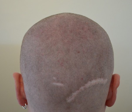 Botched result - scar in the hairline after hair transplant in Germany