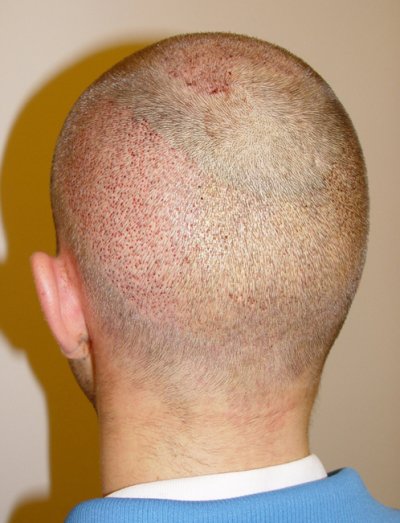 Immediately after the FUE from the back left