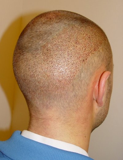 Hair transplantation with FUE: Immediately after the operation from behind right