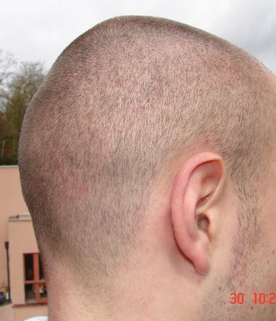 Rim of hair 4 weeks after the operation with FUE from the right back shaved to 1 mm