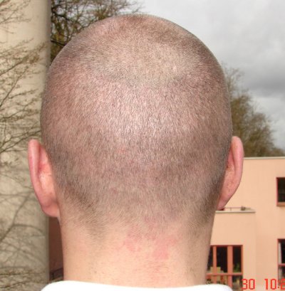 The band of hair shaved to 1 mm 4 weeks after the hair transplant with follicular unit extraction