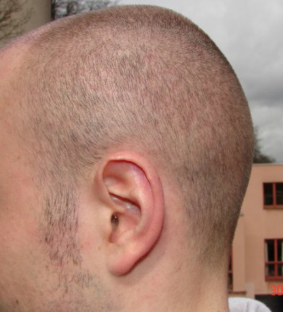 The band of hair 4 weeks after the FUE hair transplantation from the left back shaved to 1 mm