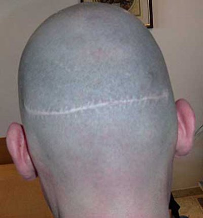 Band of hair shaved after a hair transplant with fut: The linear scar is visible