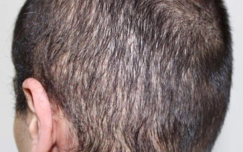 Hair transplant with low cost, but bad result and a thinned out donor area