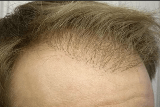 Marco`s resultant of the hair transplantation in germany and before the repair surgery from front right close, thick grafts and toilet brush effect, poor growth rate and low density