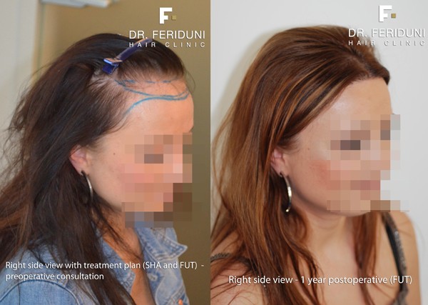 High forehead: example of combination surgical forehead reduction followed by strip hair transplantation with 1790 grafts - view from left - Feriduni