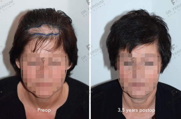 Example of a female hair transplant by Dr. Bijan Feriduni: On the left the patient before and on the right after increasing the density