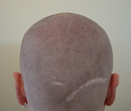 Misslungene Haartransplantationen: Beispiel einer Narbe am Hinterkopf
