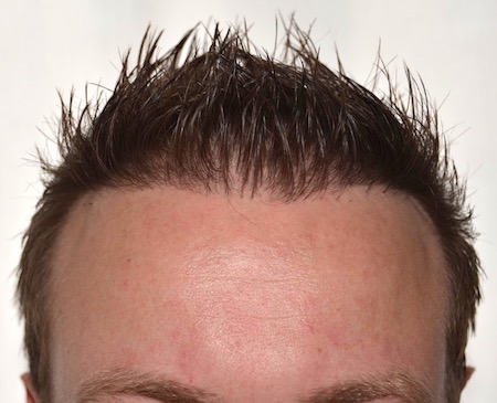 Result of the repair of a bad hair transplantation in germany, fixed by Dr. Özgür Öztan - Hairlineclinic