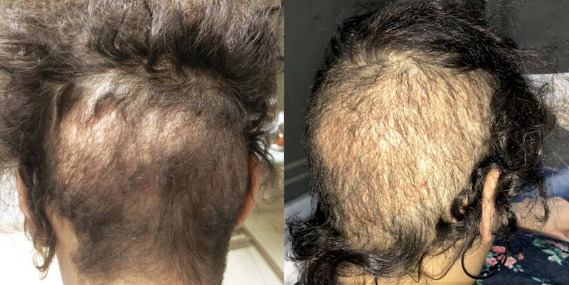 Permanent hairline thinning and irreversible FUE overharvesting in a woman: images ISHRS.org6