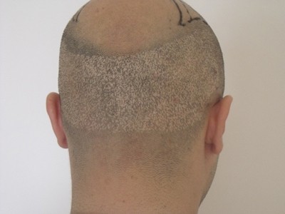 Hair transplantation risks in the donor area with FUE Example 2