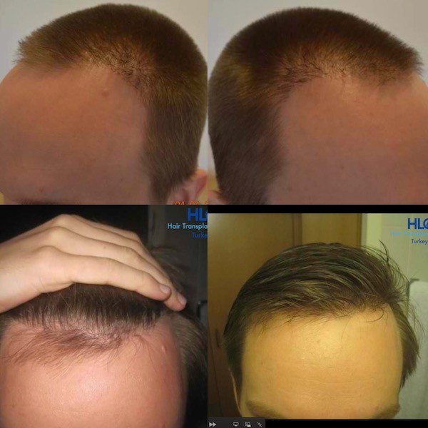 Example 3: Unsuccessful example of hair transplantation shown in the picture above, with wrong growth direction and thick grafts (multiple hair grafts) and below the result after correction