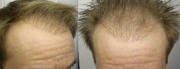 Hair transplant risks in the recipient area: Unnatural hairline, thick grafts and wrong growth direction