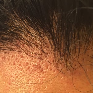 Scarring in the recipient area: pitting, clear deepening around the grafts
