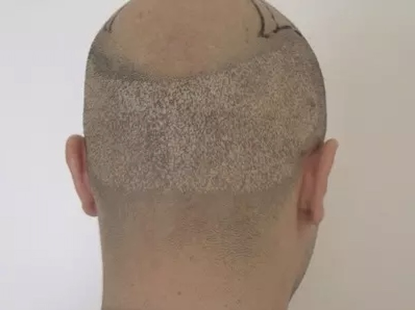 Scars and window optic after fue hair restoration