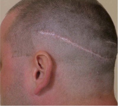 Scar after a hair transplant with fut (strip technique)