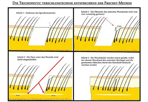 Goal Reduction of visible scars: sketch of the Trichophytic Closure technique in FUT hair transplantation