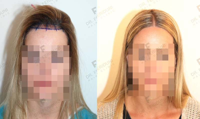 Comparison of before and after the women's repair hair restoration surgery