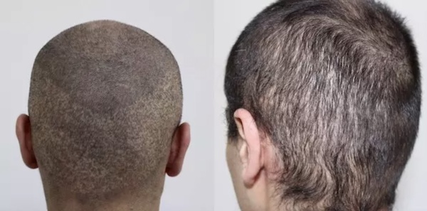 Decimated donor areas after failed FUE hair transplantation