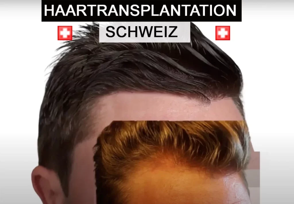 Hair Transplant Clinics and Doctors Switzerland