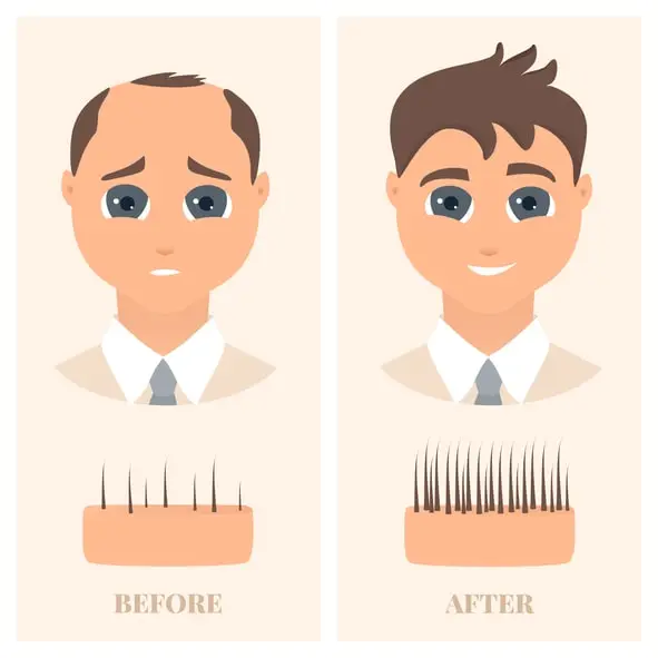 Twenty important hair transplant myths, misconceptions and facts
